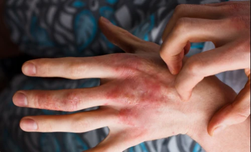 Right hand scratching left hand eczema itch.